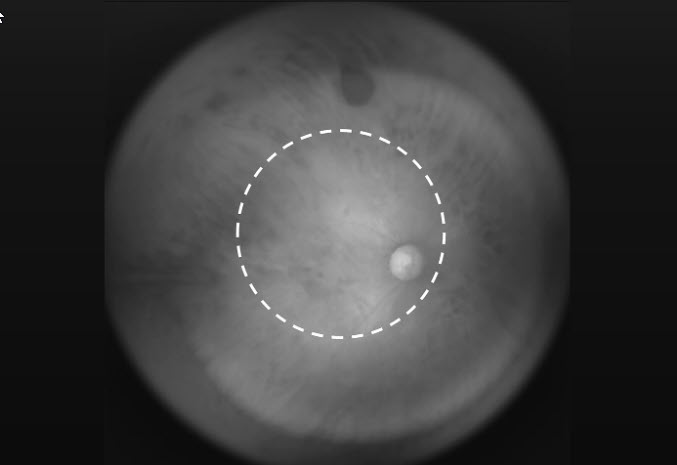 Wide angle fundus image by Near-infrared